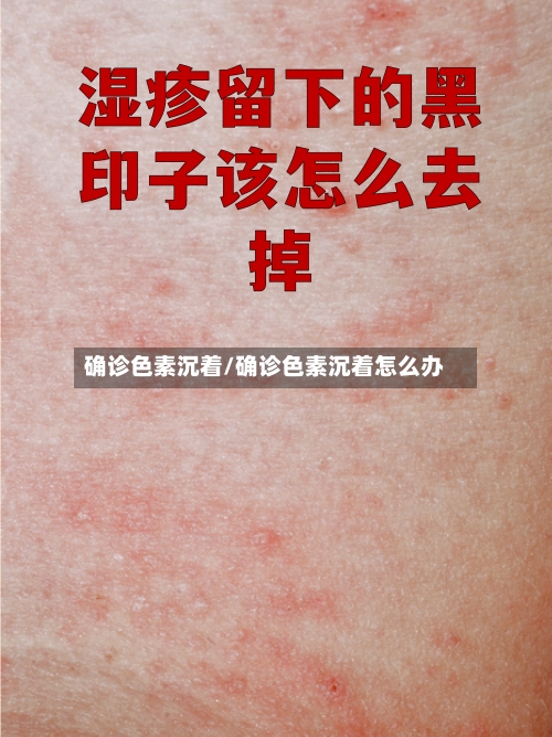 确诊色素沉着/确诊色素沉着怎么办-第2张图片