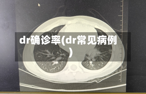 dr确诊率(dr常见病例)
